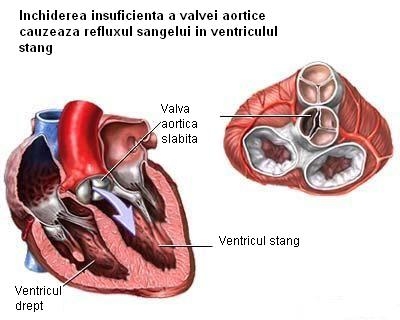 Insuficienta aortica